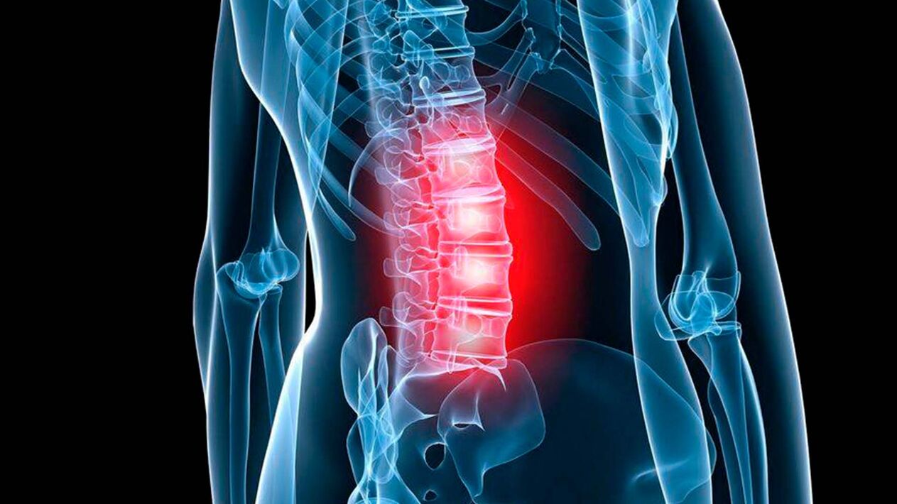 objawy osteochondrozy lędźwiowej
