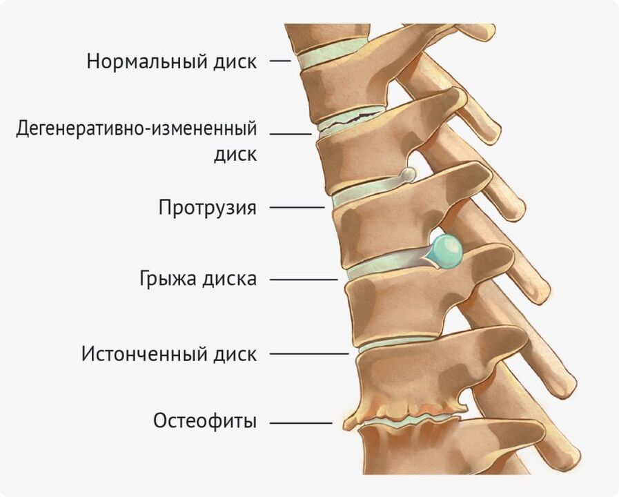 Deformacje dysku dla osteochondrozy lędźwiowej