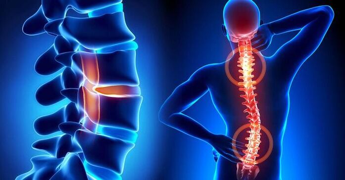 lokalizacja bólu w osteochondrozie