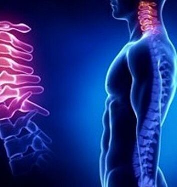 Osteochondroza szyjna może być spowodowana urazami szyi