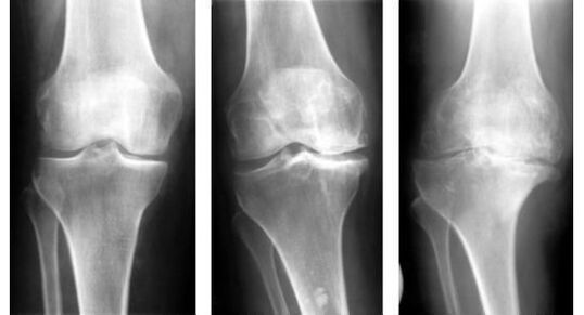Obowiązkowym środkiem diagnostycznym przy identyfikacji artrozy stawu kolanowego jest prześwietlenie